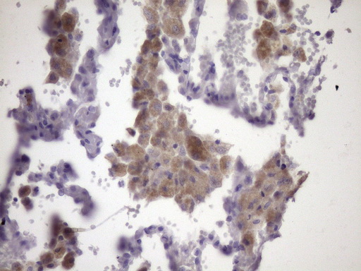 KIAA1524 / p90 Autoantigen Antibody - Immunohistochemical staining of paraffin-embedded Carcinoma of Human lung tissue using anti-KIAA1524 mouse monoclonal antibody. (Heat-induced epitope retrieval by Tris-EDTA, pH8.0)(1:150)