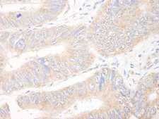 KIAA1524 / p90 Autoantigen Antibody - Detection of Human CIP2A by Immunohistochemistry. Sample: FFPE section of human colon carcinoma. Antibody: Affinity purified rabbit anti-CIP2A used at a dilution of 1:200 (1 ug/ml).