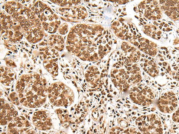 KIAA1811 / BRSK1 Antibody - Immunohistochemistry of paraffin-embedded Human esophagus cancer tissue  using BRSK1 Polyclonal Antibody at dilution of 1:95(×200)