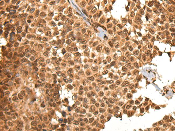 KIAA1811 / BRSK1 Antibody - Immunohistochemistry of paraffin-embedded Human ovarian cancer tissue  using BRSK1 Polyclonal Antibody at dilution of 1:95(×200)