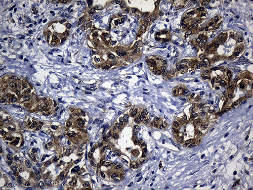 KIAA1970 / EARS2 Antibody - Immunohistochemical staining of paraffin-embedded Carcinoma of Human liver tissue using anti-EARS2 mouse monoclonal antibody. (Heat-induced epitope retrieval by 1mM EDTA in 10mM Tris buffer. (pH8.5) at 120°C for 3 min. (1:500)