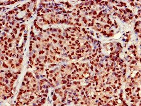 KIAA1970 / EARS2 Antibody - Immunohistochemistry of paraffin-embedded human ovarian cancer at dilution of 1:100