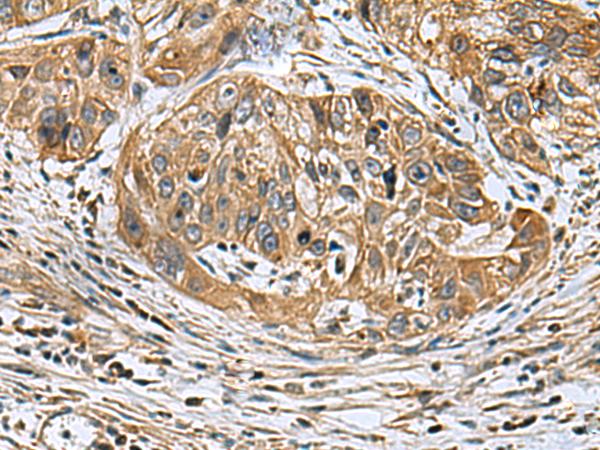 KIAA1970 / EARS2 Antibody - Immunohistochemistry of paraffin-embedded Human esophagus cancer tissue  using EARS2 Polyclonal Antibody at dilution of 1:30(×200)