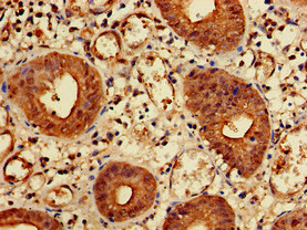 KIDINS220 / ARMS Antibody - Immunohistochemistry of paraffin-embedded human colon cancer at dilution of 1:100