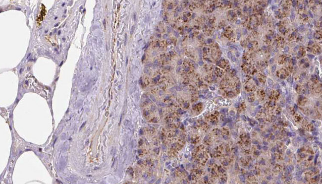 KIDINS220 / ARMS Antibody - 1:100 staining human pancreas carcinoma tissue by IHC-P. The sample was formaldehyde fixed and a heat mediated antigen retrieval step in citrate buffer was performed. The sample was then blocked and incubated with the antibody for 1.5 hours at 22°C. An HRP conjugated goat anti-rabbit antibody was used as the secondary.