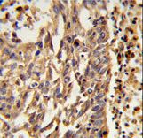KIF11 / EG5 Antibody - Formalin-fixed and paraffin-embedded human lung carcinoma reacted with KIF11 Antibody , which was peroxidase-conjugated to the secondary antibody, followed by DAB staining. This data demonstrates the use of this antibody for immunohistochemistry; clinical relevance has not been evaluated.