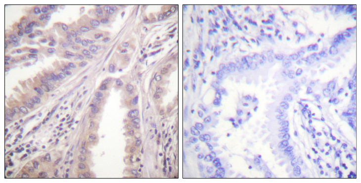 KIF11 / EG5 Antibody - Immunohistochemistry analysis of paraffin-embedded human lung carcinoma tissue, using KIF11/Eg5 Antibody. The picture on the right is blocked with the synthesized peptide.
