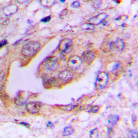 KIF11 / EG5 Antibody - Immunohistochemical analysis of EG5 (pT926) staining in human lung cancer formalin fixed paraffin embedded tissue section. The section was pre-treated using heat mediated antigen retrieval with sodium citrate buffer (pH 6.0). The section was then incubated with the antibody at room temperature and detected using an HRP conjugated compact polymer system. DAB was used as the chromogen. The section was then counterstained with hematoxylin and mounted with DPX.