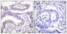 KIF11 / EG5 Antibody - P-peptide - + Immunohistochemistry analysis of paraffin-embedded human lung carcinoma tissue using KIF11/Eg5 (Phospho-Thr926) antibody.