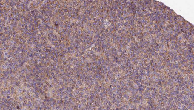 KIF12 Antibody - 1:100 staining human lymph carcinoma tissue by IHC-P. The sample was formaldehyde fixed and a heat mediated antigen retrieval step in citrate buffer was performed. The sample was then blocked and incubated with the antibody for 1.5 hours at 22°C. An HRP conjugated goat anti-rabbit antibody was used as the secondary.