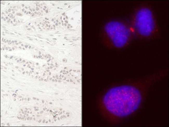 KIF14 Antibody - Detection of Human KIF14 by Immunohistochemistry and Immunocytochemistry. Sample: FFPE section of human breast carcinoma (left) and formaldelyde-fixed HeLa cells (right). Antibody: Affinity purified rabbit anti-KIF14 used at a dilution of 1:200 (1and 1:100 (2 Detection: DAB (left) and red-fluorescent goat anti-rabbit IgG highly cross-adsorbed Antibody used at a dilution of 1:100 (right).