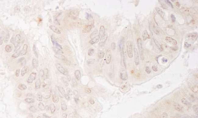 KIF14 Antibody - Detection of Human KIF14 by Immunohistochemistry. Sample: FFPE section of human colon carcinoma. Antibody: Affinity purified rabbit anti-KIF14 used at a dilution of 1:1000 (1 Detection: DAB.