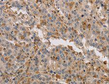 KIF17 Antibody - Immunohistochemistry of paraffin-embedded Human liver cancer using KIF17 Polyclonal Antibody at dilution of 1:40.