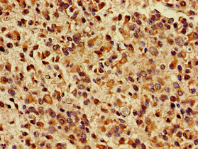 KIF17 Antibody - Immunohistochemistry of paraffin-embedded human glioma cancer at dilution of 1:100