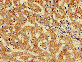 KIF17 Antibody - Immunohistochemistry of paraffin-embedded human liver cancer at dilution of 1:100