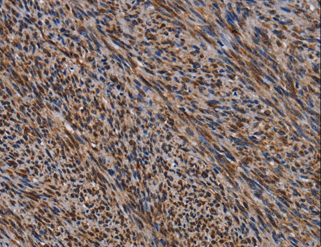 KIF1C Antibody - Immunohistochemistry of paraffin-embedded Human sarcoma using KIF1C Polyclonal Antibody at dilution of 1:60.