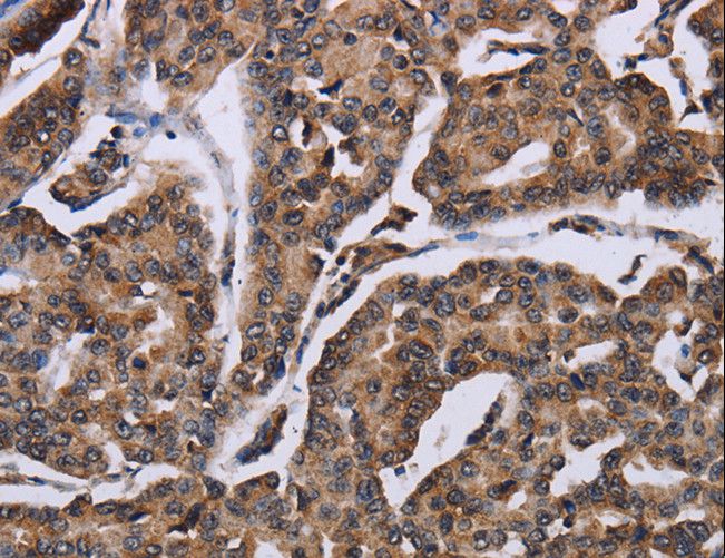 KIF1C Antibody - Immunohistochemistry of paraffin-embedded Human breast cancer using KIF1C Polyclonal Antibody at dilution of 1:60.