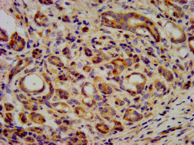 KIF20B Antibody - Immunohistochemistry image at a dilution of 1:400 and staining in paraffin-embedded human pancreatic cancer performed on a Leica BondTM system. After dewaxing and hydration, antigen retrieval was mediated by high pressure in a citrate buffer (pH 6.0) . Section was blocked with 10% normal goat serum 30min at RT. Then primary antibody (1% BSA) was incubated at 4 °C overnight. The primary is detected by a biotinylated secondary antibody and visualized using an HRP conjugated SP system.