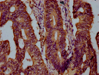KIF21B Antibody - Immunohistochemistry Dilution at 1:300 and staining in paraffin-embedded human colon cancer performed on a Leica BondTM system. After dewaxing and hydration, antigen retrieval was mediated by high pressure in a citrate buffer (pH 6.0). Section was blocked with 10% normal Goat serum 30min at RT. Then primary antibody (1% BSA) was incubated at 4°C overnight. The primary is detected by a biotinylated Secondary antibody and visualized using an HRP conjugated SP system.