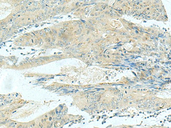 KIF21B Antibody - Immunohistochemistry of paraffin-embedded Human colorectal cancer tissue  using KIF21B Polyclonal Antibody at dilution of 1:40(×200)