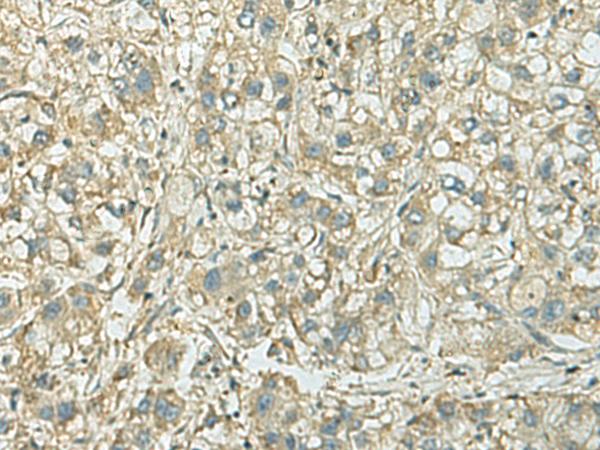 KIF21B Antibody - Immunohistochemistry of paraffin-embedded Human liver cancer tissue  using KIF21B Polyclonal Antibody at dilution of 1:40(×200)