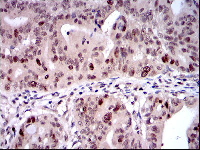KIF22 / OBP Antibody - IHC of paraffin-embedded rectum cancer tissues using KID mouse monoclonal antibody with DAB staining.