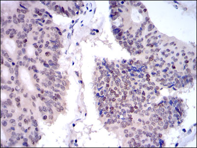 KIF22 / OBP Antibody - IHC of paraffin-embedded colon cancer tissues using KID mouse monoclonal antibody with DAB staining.