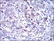 KIF22 / OBP Antibody - IHC of paraffin-embedded cervical cancer tissues using KID mouse monoclonal antibody with DAB staining.