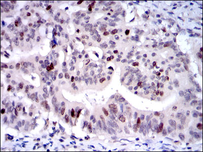 KIF22 / OBP Antibody - IHC of paraffin-embedded rectum cancer tissues using KID mouse monoclonal antibody with DAB staining.