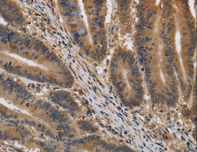 KIF22 / OBP Antibody - Immunohistochemistry of paraffin-embedded Human liver cancer using KIF22 Polyclonal Antibody at dilution of 1:40.