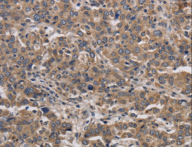 KIF22 / OBP Antibody - Immunohistochemistry of paraffin-embedded Human liver cancer using KIF22 Polyclonal Antibody at dilution of 1:40.