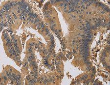 KIF22 / OBP Antibody - Immunohistochemistry of paraffin-embedded Human colon cancer using KIF22 Polyclonal Antibody at dilution of 1:30.