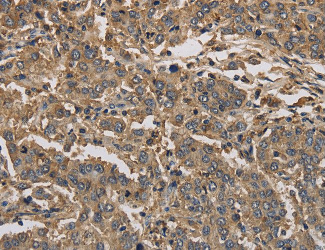 KIF22 / OBP Antibody - Immunohistochemistry of paraffin-embedded Human liver cancer using KIF22 Polyclonal Antibody at dilution of 1:30.