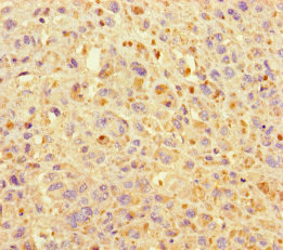 KIF24 Antibody - Immunohistochemistry of paraffin-embedded human melanoma using KIF24 Antibody at dilution of 1:100