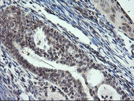KIF25 Antibody - IHC of paraffin-embedded Adenocarcinoma of Human endometrium tissue using anti-KIF25 mouse monoclonal antibody.