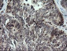 KIF25 Antibody - IHC of paraffin-embedded Adenocarcinoma of Human ovary tissue using anti-KIF25 mouse monoclonal antibody.