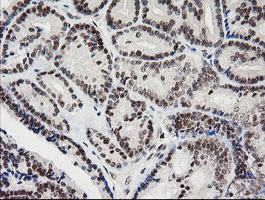 KIF25 Antibody - IHC of paraffin-embedded Carcinoma of Human thyroid tissue using anti-KIF25 mouse monoclonal antibody.