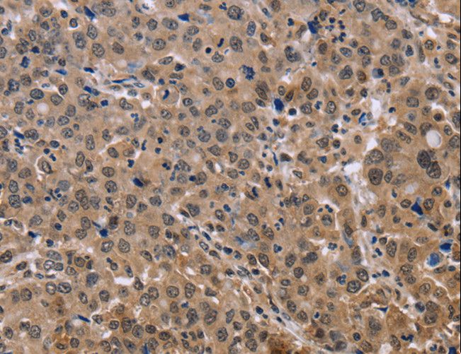 KIF25 Antibody - Immunohistochemistry of paraffin-embedded Human thyroid cancer using KIF25 Polyclonal Antibody at dilution of 1:40.