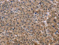 KIF25 Antibody - Immunohistochemistry of paraffin-embedded Human thyroid cancer using KIF25 Polyclonal Antibody at dilution of 1:40.