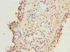 KIF26B Antibody - Immunohistochemistry of paraffin-embedded human breast cancer using antibody at dilution of 1:100.