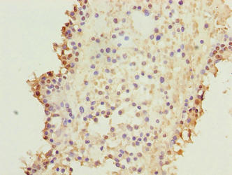 KIF26B Antibody - Immunohistochemistry of paraffin-embedded human breast cancer using KIF26B Antibody at dilution of 1:100