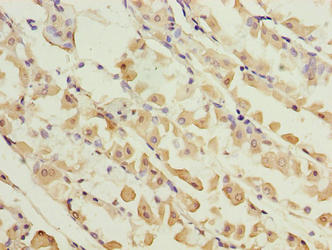 KIF26B Antibody - Immunohistochemistry of paraffin-embedded human gastric cancer using KIF26B Antibody at dilution of 1:100