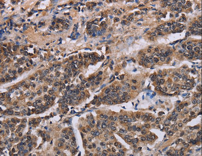KIF2A Antibody - Immunohistochemistry of paraffin-embedded Human breast cancer using KIF2A Polyclonal Antibody at dilution of 1:30.