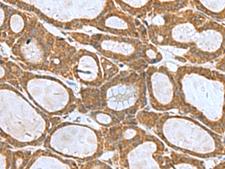 KIF2A Antibody - Immunohistochemistry of paraffin-embedded Human thyroid cancer tissue  using KIF2A Polyclonal Antibody at dilution of 1:55(×200)