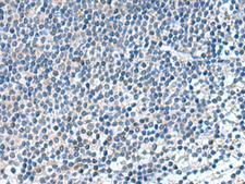 KIF2A Antibody - Immunohistochemistry of paraffin-embedded Human tonsil tissue  using KIF2A Polyclonal Antibody at dilution of 1:65(×200)