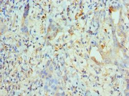KIF2C / MCAK Antibody - Immunohistochemistry of paraffin-embedded human lung cancer using antibody at 1:100 dilution.