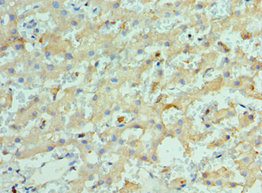 KIF2C / MCAK Antibody - Immunohistochemistry of paraffin-embedded human liver cancer using KIF2C Antibody at dilution of 1:100