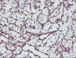 KIF2C / MCAK Antibody - IHC of paraffin-embedded Carcinoma of Human kidney tissue using anti-KIF2C mouse monoclonal antibody. (Heat-induced epitope retrieval by 10mM citric buffer, pH6.0, 100C for 10min).
