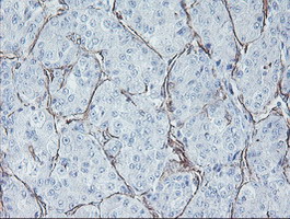 KIF2C / MCAK Antibody - IHC of paraffin-embedded Carcinoma of Human liver tissue using anti-KIF2C mouse monoclonal antibody. (Heat-induced epitope retrieval by 10mM citric buffer, pH6.0, 100C for 10min).
