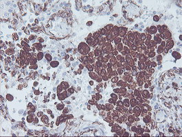 KIF2C / MCAK Antibody - IHC of paraffin-embedded Carcinoma of Human lung tissue using anti-KIF2C mouse monoclonal antibody. (Heat-induced epitope retrieval by 10mM citric buffer, pH6.0, 100C for 10min).
